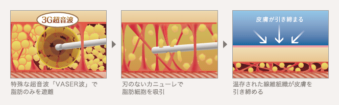特殊な超音波「VASER波」で脂肪のみを遊離 / 刃のないカニューレで脂肪細胞を吸引 / 温存された線維組織が皮膚を引き締める