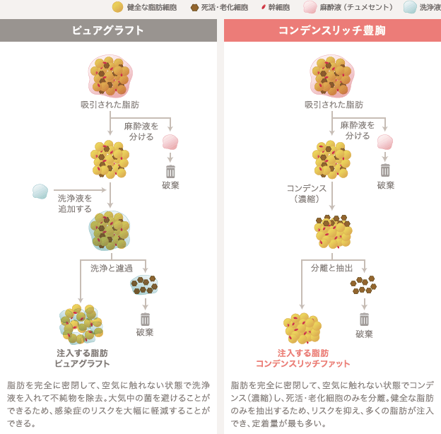 ピュアグラフト: 脂肪を完全に密閉して、空気に触れない状態で洗浄液を入れて不純物を除去。大気中の菌を避けることができるため、感染症のリスクを大幅に軽減することができる。 | コンデンスリッチ豊胸: 脂肪を完全に密閉して、空気に触れない状態でコンデンス(濃縮)し、死活・老化細胞のみを分離。健全な脂肪のみを抽出するため、リスクを抑え、多くの脂肪が注入でき、定着量が最も多い。