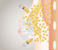 マルチプルインジェクション技術