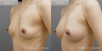 女性/40歳のコンデンスリッチ豊胸の症例画像