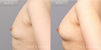 女性/40歳のコンデンスリッチ豊胸の症例画像