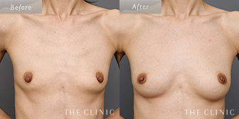 女性/40歳のコンデンスリッチ豊胸の症例画像