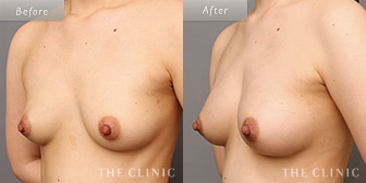 女性/40歳のコンデンスリッチ豊胸の症例画像