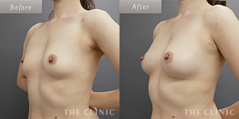 女性/40歳のコンデンスリッチ豊胸の症例画像