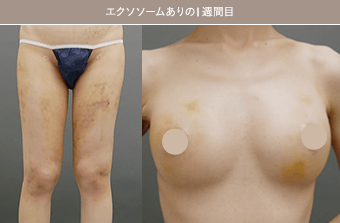 エクソソーム有り豊胸手術後の1週間目
