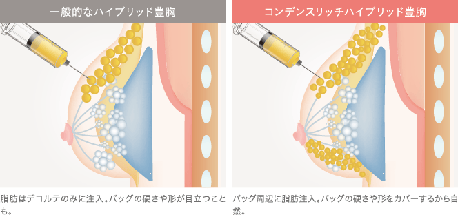 一般的なハイブリッド豊胸とコンデンスリッチハイブリッド豊胸の違い