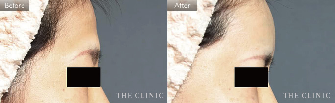 おでこのくぼみ改善のためのコンデンスリッチフェイス(顔の脂肪注入)の症例