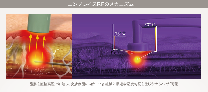 エンブレイスRFのメカニズム：脂肪を直接高温で加熱し、皮膚表面に向かって各組織に最適な温度勾配を生じさせることが可能