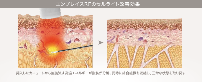 エンブレイスRFのセルライト改善効果：挿入したカニューレから直接流す高温エネルギーが脂肪が分解。同時に結合組織も収縮し、正常な状態を取り戻す