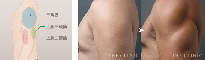 FTMの症例 たくましい上腕をつくるベイザー4Dスカルプト