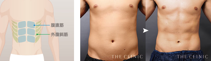 FTMの症例 鍛え上げたようなシックスパックをつくるベイザー4Dスカルプト