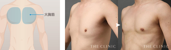 FTMの症例 男らしい胸板をつくるベイザー4Dスカルプト