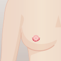乳腺切除＋脂肪吸引＋レヌビオン の手順 乳腺切除（U字切開）