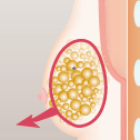 乳腺切除＋脂肪吸引＋レヌビオン の手順 脂肪吸引