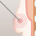 乳腺切除＋脂肪吸引＋レヌビオン の手順 レヌビオン