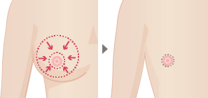 乳輪全周切開(O字切開) 切開箇所