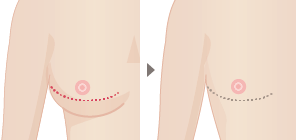 乳房の下部を切開 切開箇所