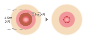 乳頭周囲法 切除箇所