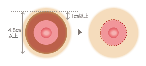 乳輪外周法 切除箇所