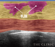 真性女性化乳房