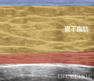 偽性女性化乳房