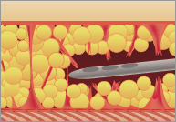 従来の脂肪吸引1