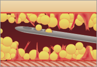 従来の脂肪吸引2
