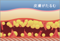 従来の脂肪吸引3