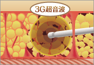 ベイザー脂肪吸引1