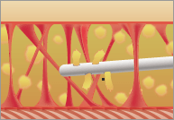 ベイザー脂肪吸引2