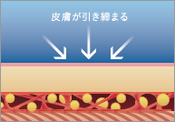 ベイザー脂肪吸引3