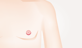 一般的な乳腺切除の図