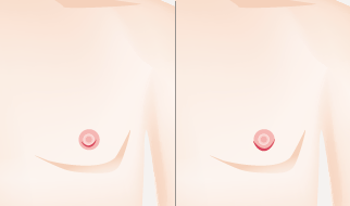 当院の乳腺切除の図