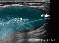 溶解液注入