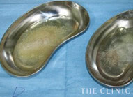 除去したヒアルロン酸