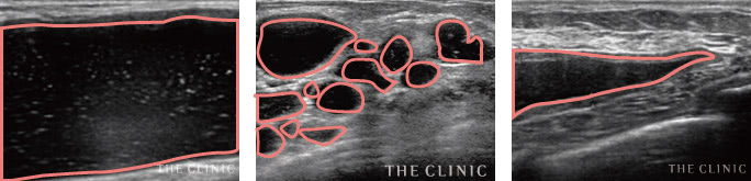ヒアルロン酸注入豊胸のリスク