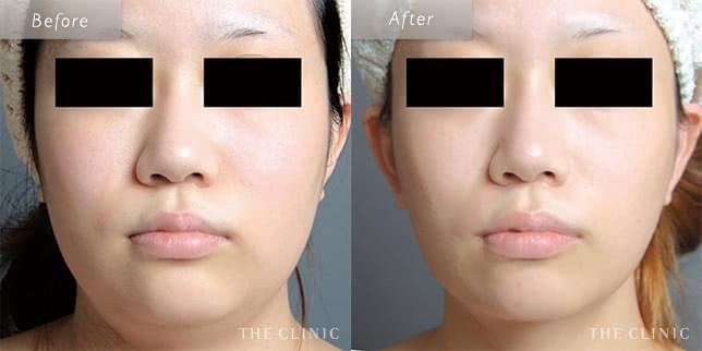 脂肪吸引:顔のビフォーアフター(23歳女性)