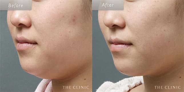 脂肪吸引:顔のビフォーアフター(23歳女性)