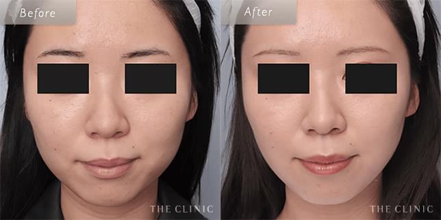 脂肪吸引:顔のビフォーアフター(21歳女性)