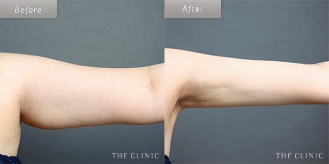 脂肪吸引:二の腕のビフォーアフター(23歳女性)