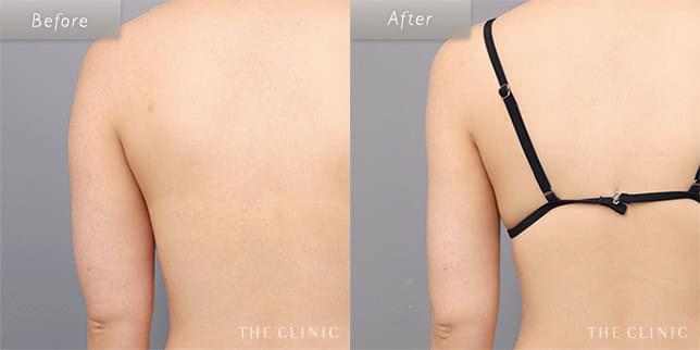脂肪吸引:二の腕のビフォーアフター(25歳女性)