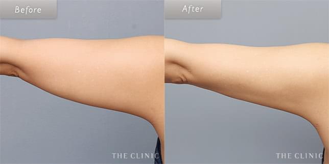 脂肪吸引:二の腕のビフォーアフター(39歳女性)