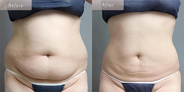 脂肪吸引:お腹のビフォーアフター(34歳女性)