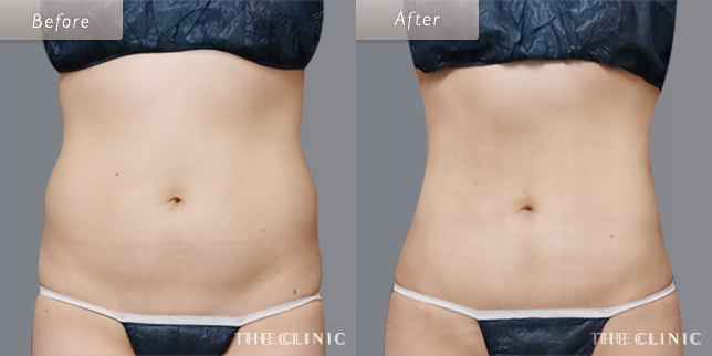 脂肪吸引:お腹のビフォーアフター(34歳女性)