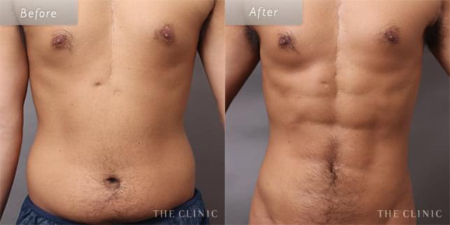 脂肪吸引:お腹のビフォーアフター(28歳男性)