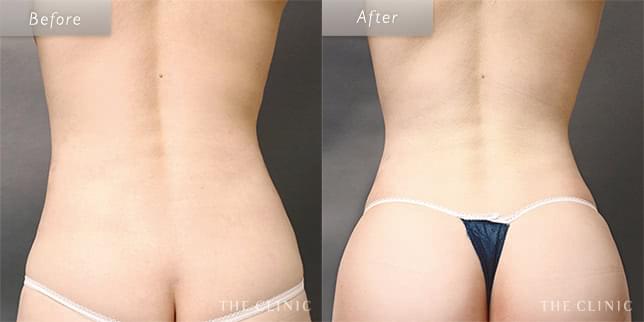 脂肪吸引:くびれのビフォーアフター(35歳女性)