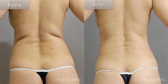 脂肪吸引:くびれのビフォーアフター(46歳女性)