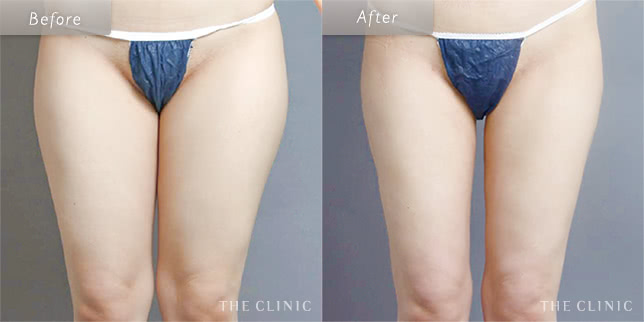 脂肪吸引:太もものビフォーアフター(25歳女性)