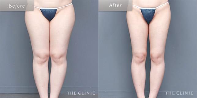 脂肪吸引:太もものビフォーアフター(26歳女性)