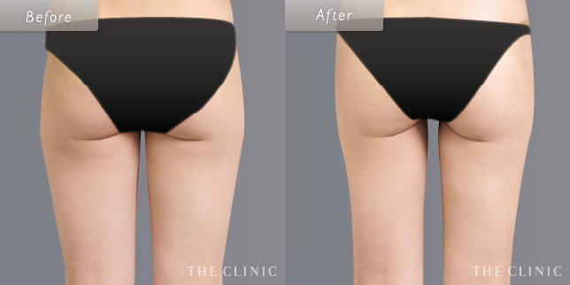 脂肪吸引:太もものビフォーアフター(23歳女性)